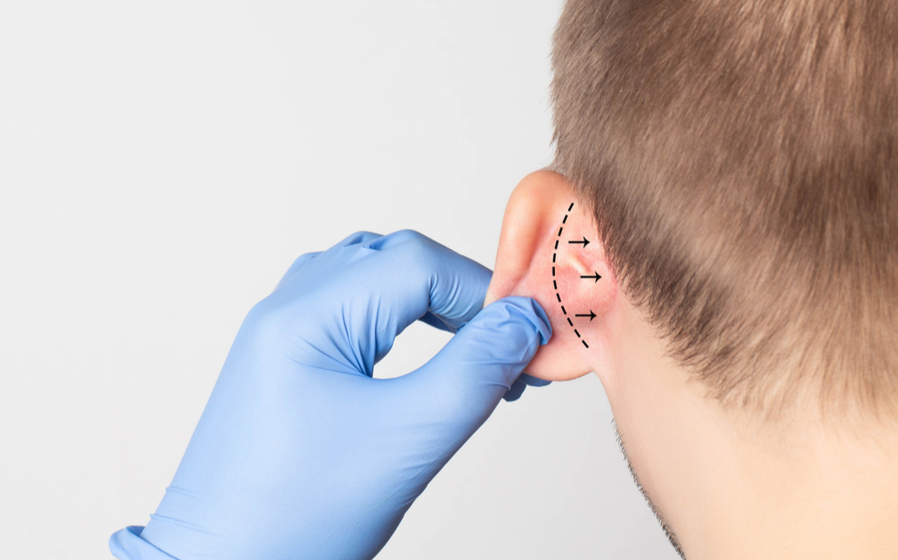 تجميل الاذن دكتور محمود مندور تجميل الأذن