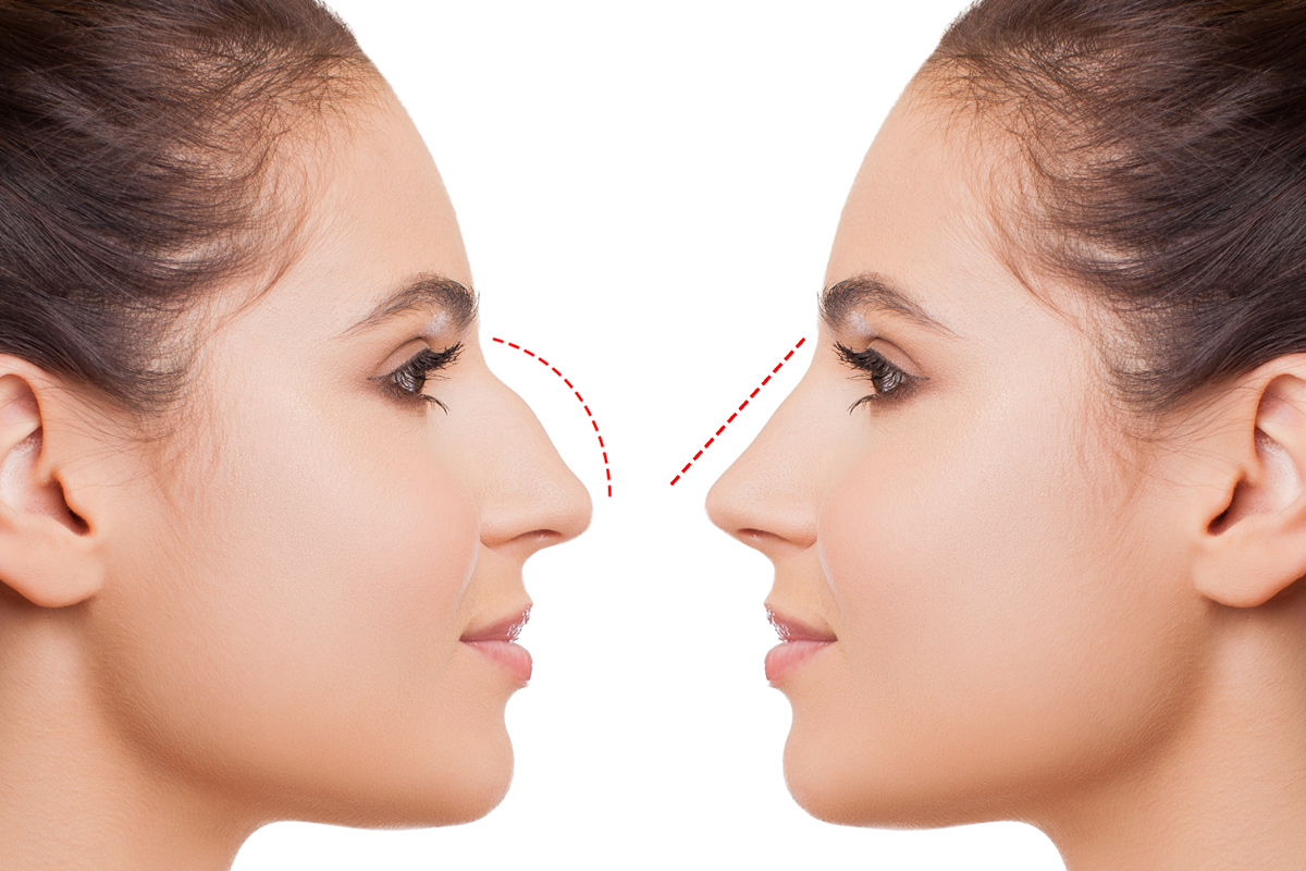تجميل النف دكتور محمود مندور تجميل الأنف
