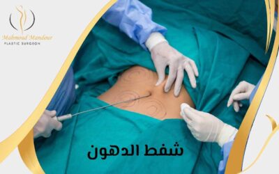 شفط الدهون